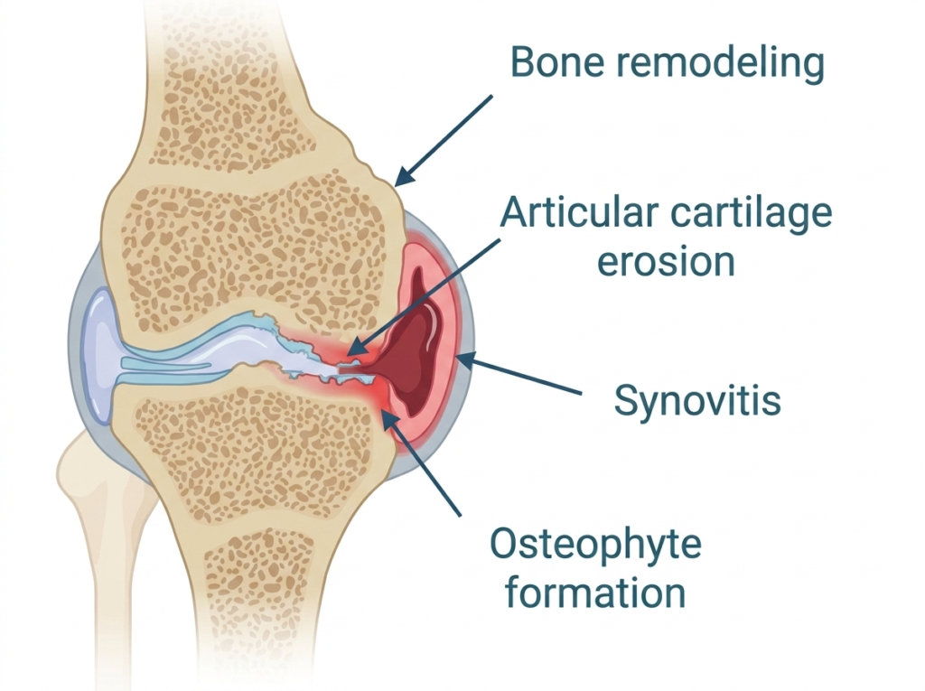 Subchondral Bone Damage in Osteoarthritis